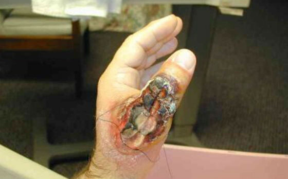 Результат укуса амазонского паука-отшельника. Из интернета