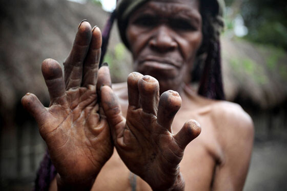 Отрубленные пальцы — знак скорби по умершим близким родственникам. Фото из интернета