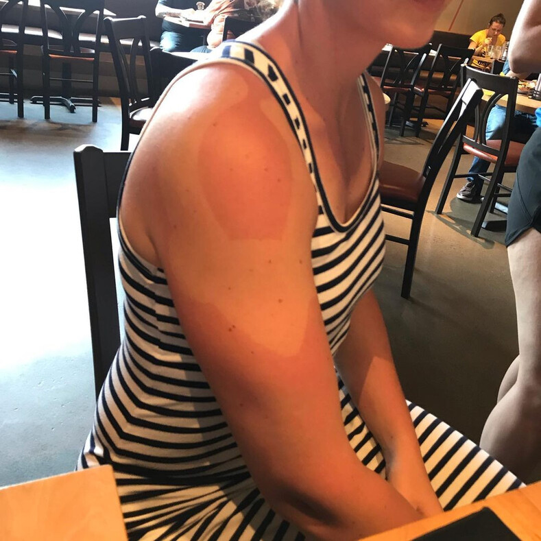 Пользователи не постеснялись показать свой худший загар, и это та еще катастрофа: 10 фотомотиваторов, чтобы всегда носить с собой солнцезащитный крем